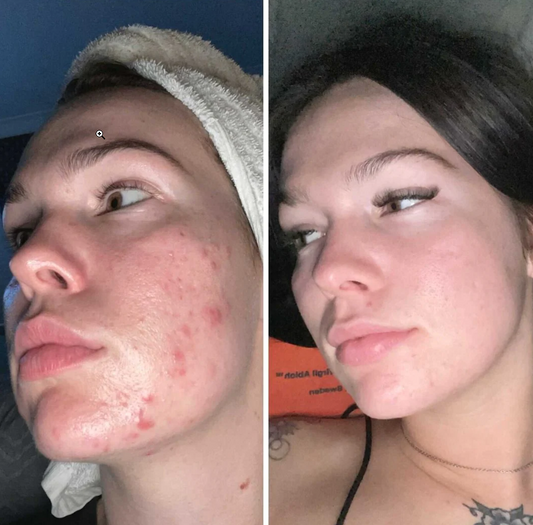 How to Manage Acne